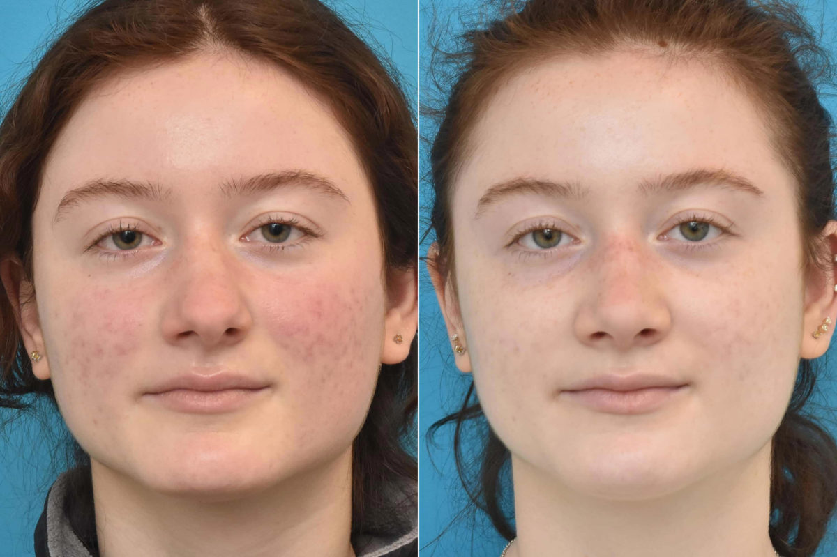 Rhinoplasty Before and After Photos in Philadelphia, PA, Patient 3230