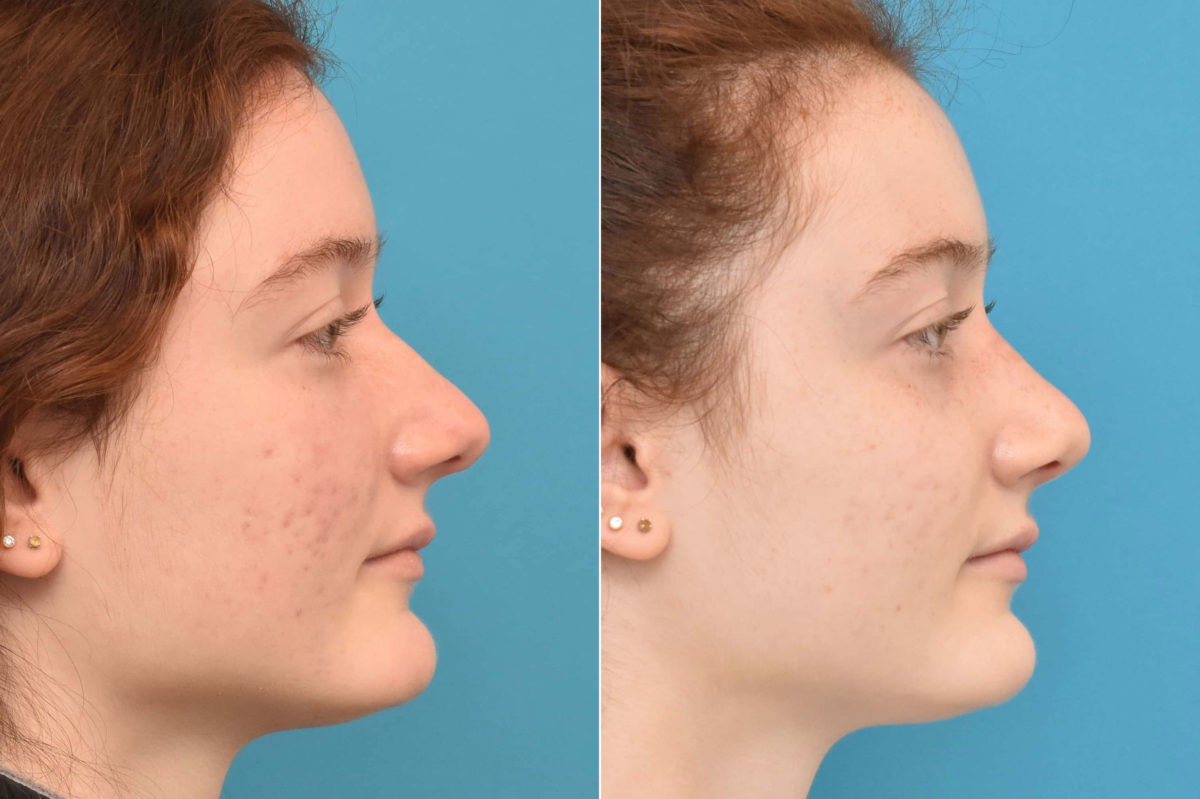 Rhinoplasty Before and After Photos in Philadelphia, PA, Patient 3230