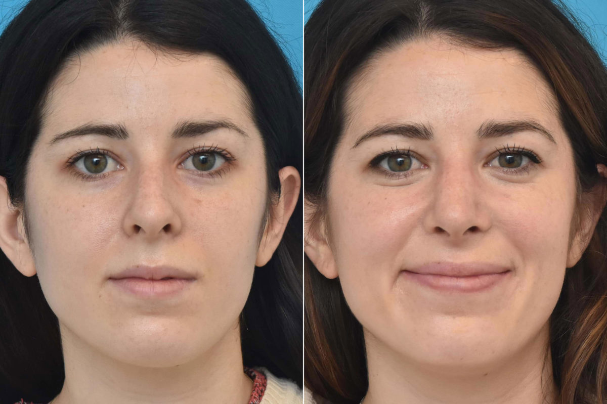 Rhinoplasty Before and After Photos in Philadelphia, PA, Patient 3234