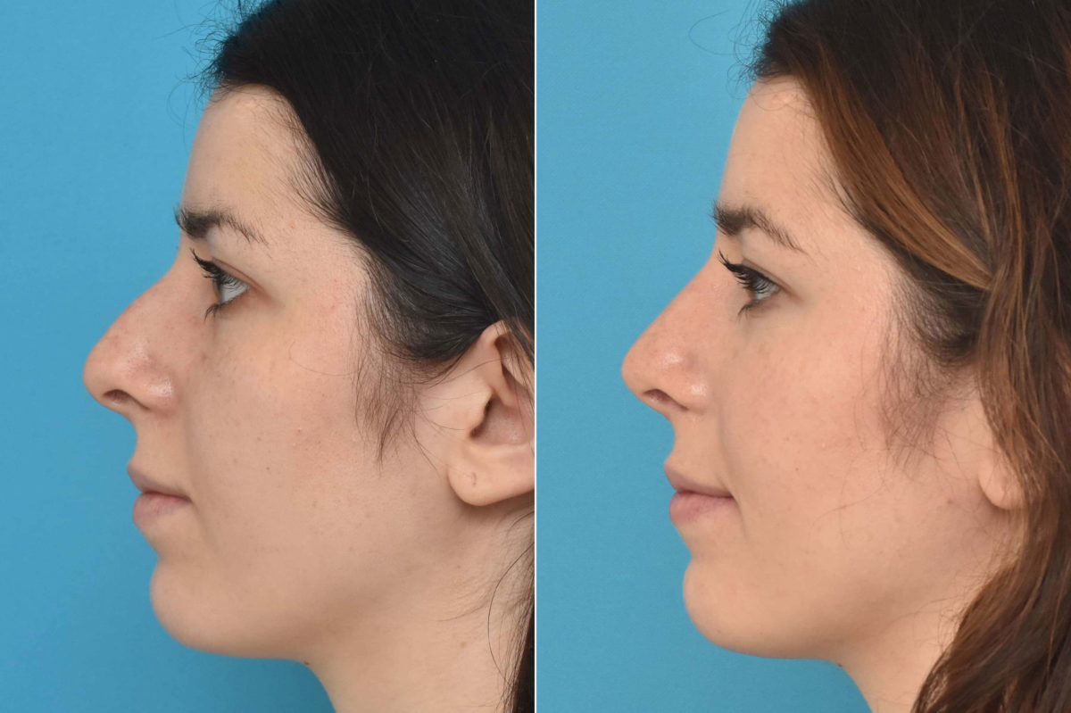 Rhinoplasty Before and After Photos in Philadelphia, PA, Patient 3234