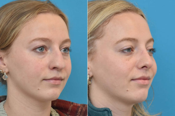 Rhinoplasty Before and After Photos in Philadelphia, PA, Patient 3237