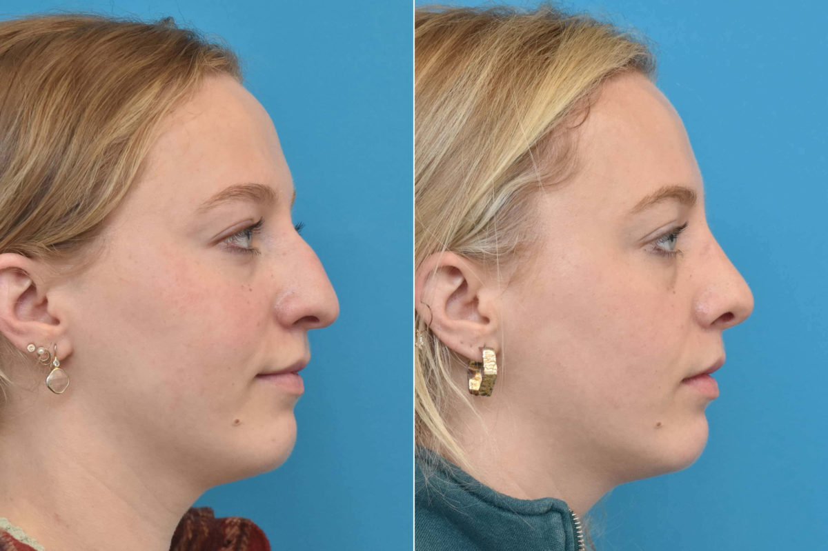 Rhinoplasty Before and After Photos in Philadelphia, PA, Patient 3237