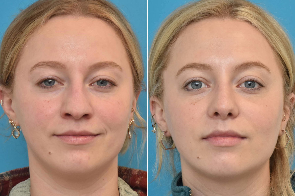 Rhinoplasty Before and After Photos in Philadelphia, PA, Patient 3237