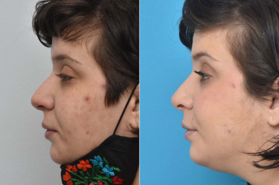 Rhinoplasty Before and After Photos in Philadelphia, PA, Patient 3287