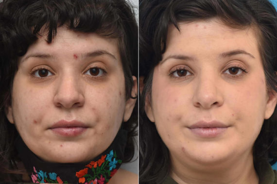 Rhinoplasty Before and After Photos in Philadelphia, PA, Patient 3287