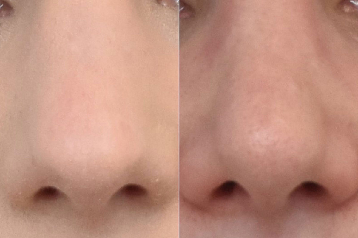 Rhinoplasty Before and After Photos in Philadelphia, PA, Patient 3290