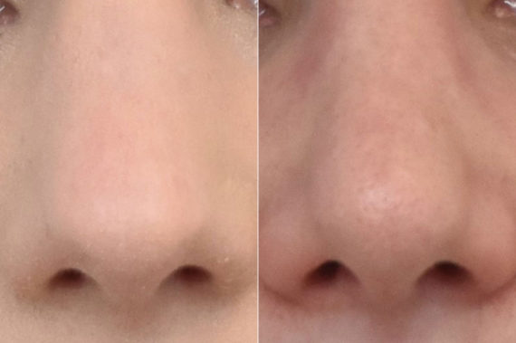 Rhinoplasty Before and After Photos in Philadelphia, PA, Patient 3290