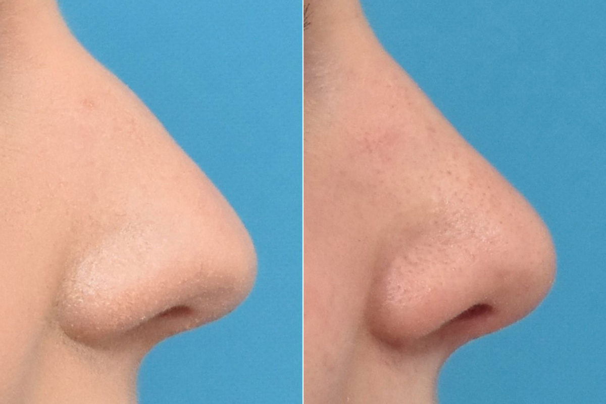 Rhinoplasty Before and After Photos in Philadelphia, PA, Patient 3290