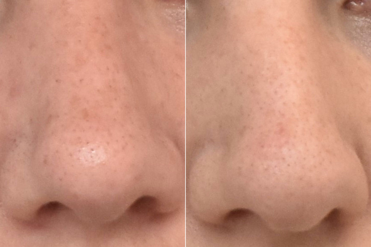 Rhinoplasty Before and After Photos in Philadelphia, PA, Patient 3293