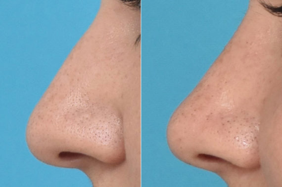 Rhinoplasty Before and After Photos in Philadelphia, PA, Patient 3293