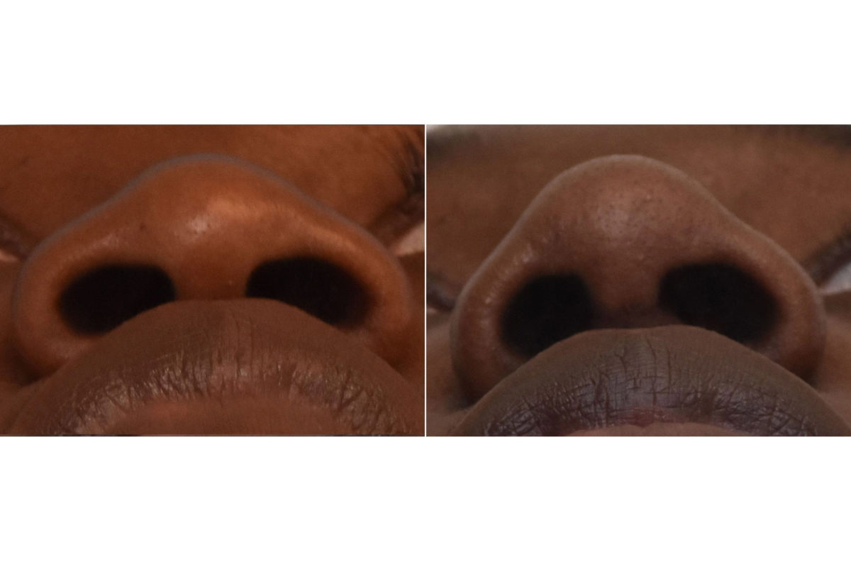 Rhinoplasty Before and After Photos in Philadelphia, PA, Patient 3297