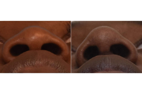 Rhinoplasty Before and After Photos in Philadelphia, PA, Patient 3297