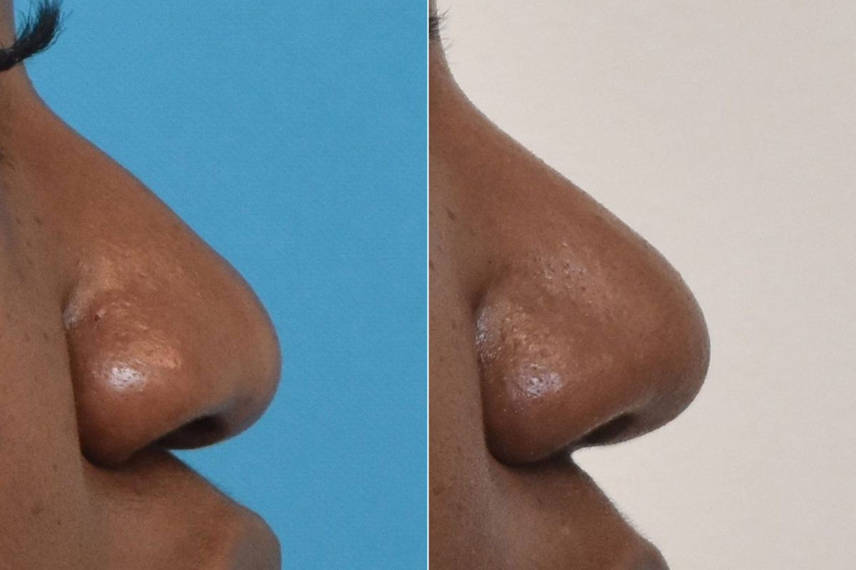 Rhinoplasty Before and After Photos in Philadelphia, PA, Patient 3297