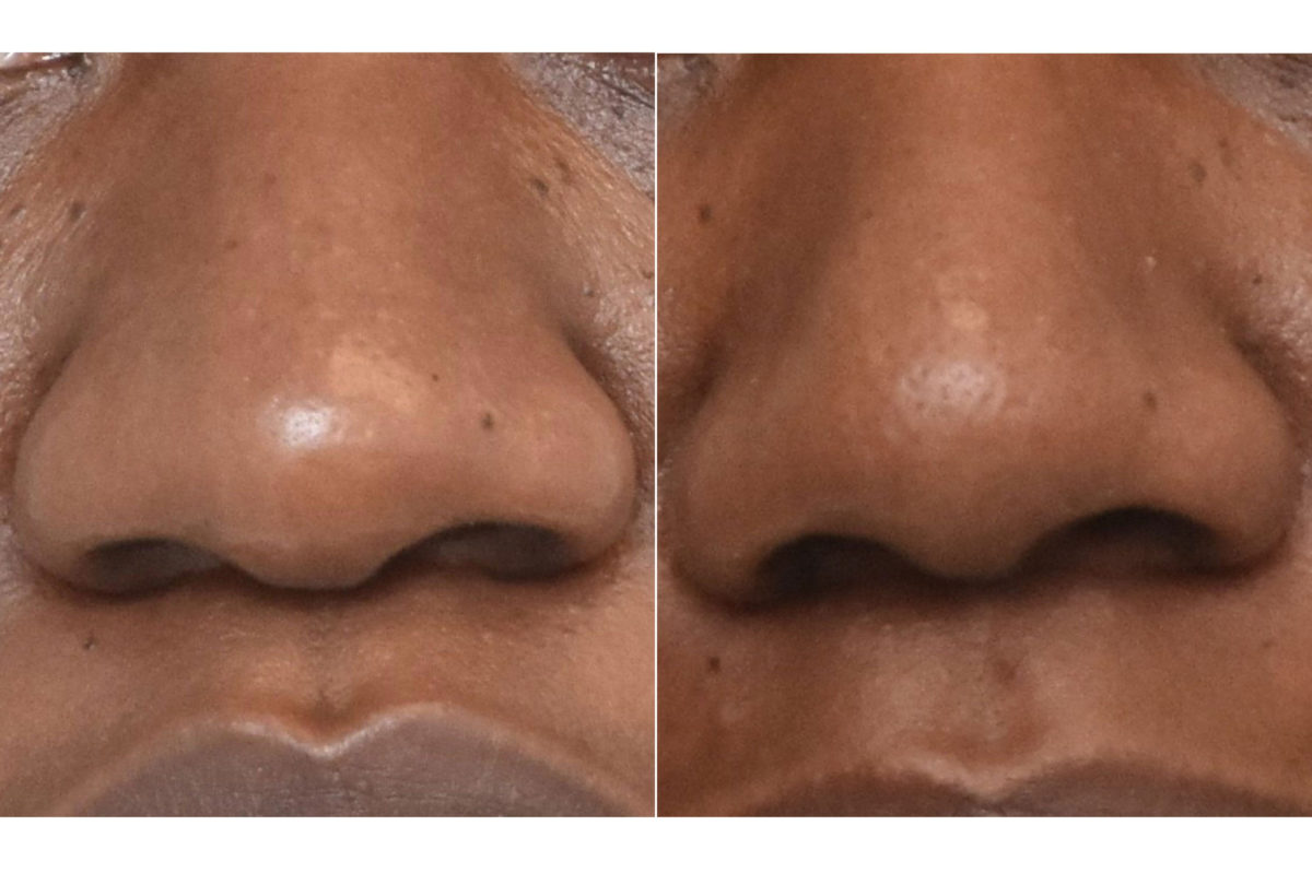 Rhinoplasty Before and After Photos in Philadelphia, PA, Patient 3297