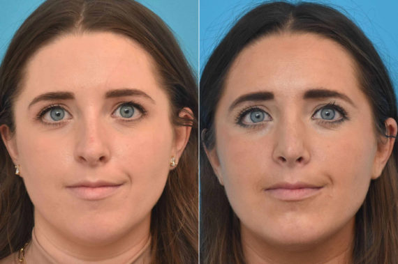 Rhinoplasty Before and After Photos in Philadelphia, PA, Patient 3301