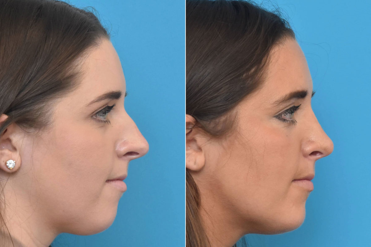 Rhinoplasty Before and After Photos in Philadelphia, PA, Patient 3301