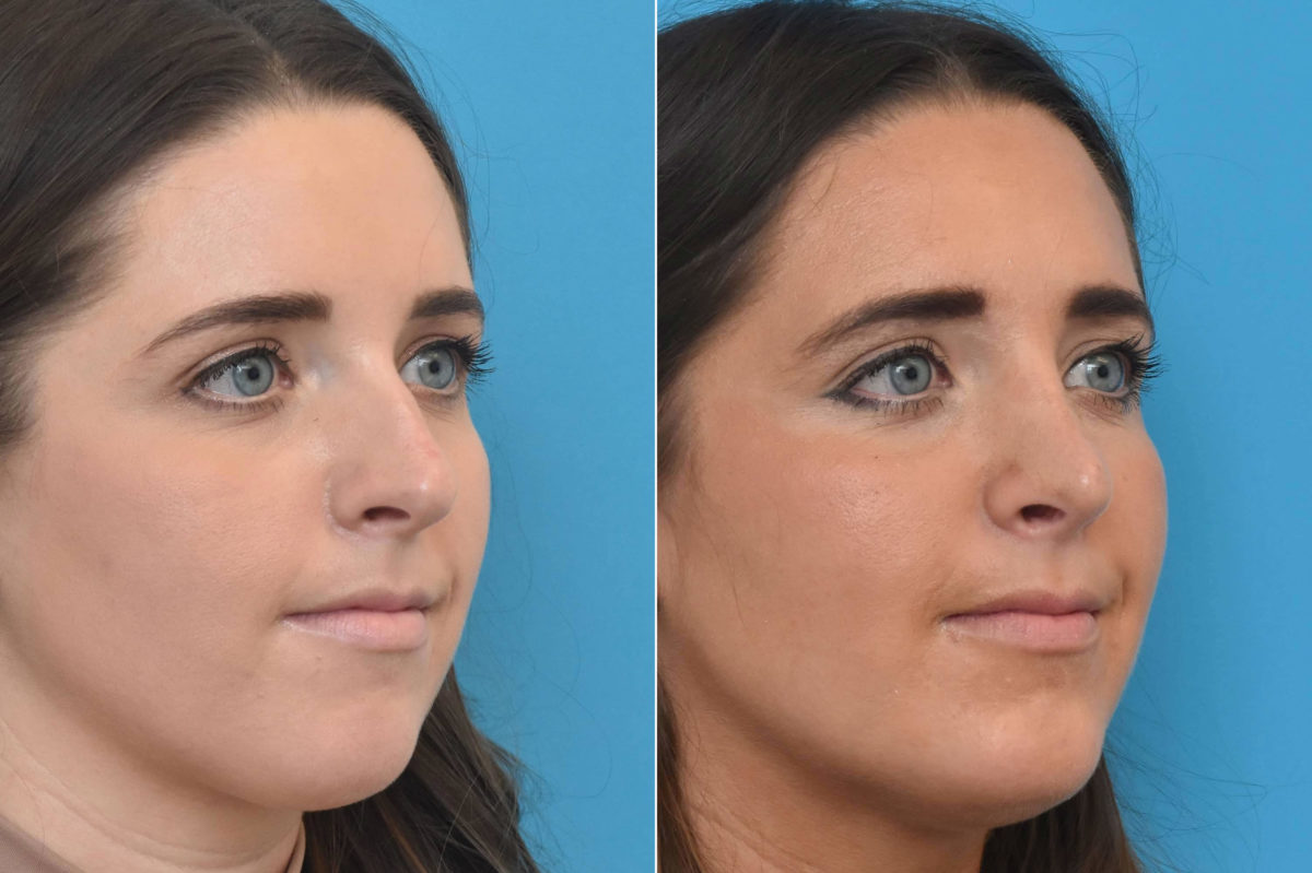 Rhinoplasty Before and After Photos in Philadelphia, PA, Patient 3301