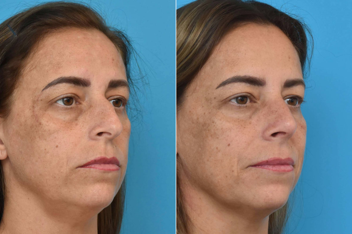 Rhinoplasty Before and After Photos in Philadelphia, PA, Patient 3306