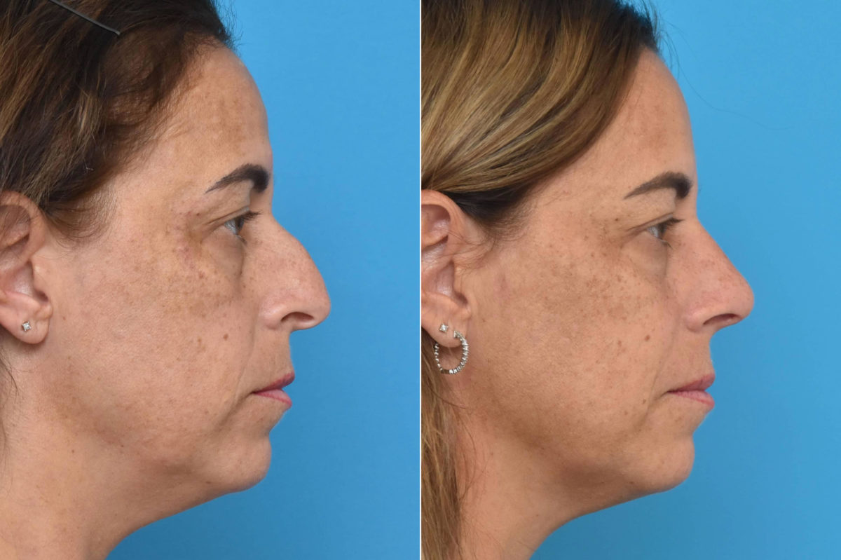 Rhinoplasty Before and After Photos in Philadelphia, PA, Patient 3306