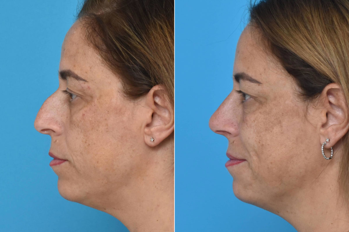 Rhinoplasty Before and After Photos in Philadelphia, PA, Patient 3306