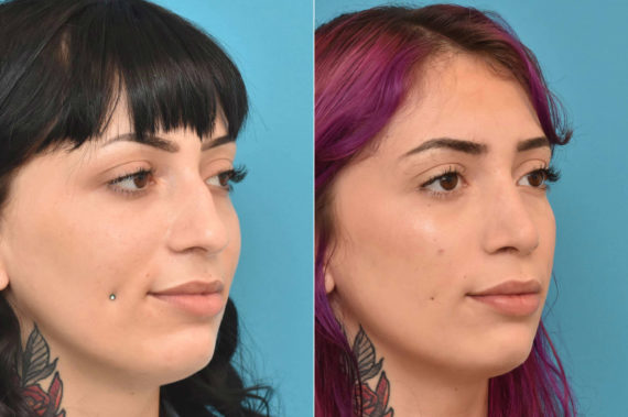Rhinoplasty Before and After Photos in Philadelphia, PA, Patient 3311