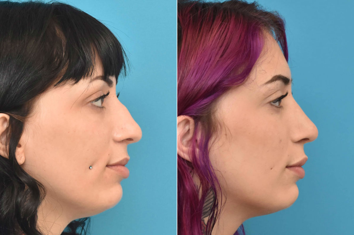 Rhinoplasty Before and After Photos in Philadelphia, PA, Patient 3311