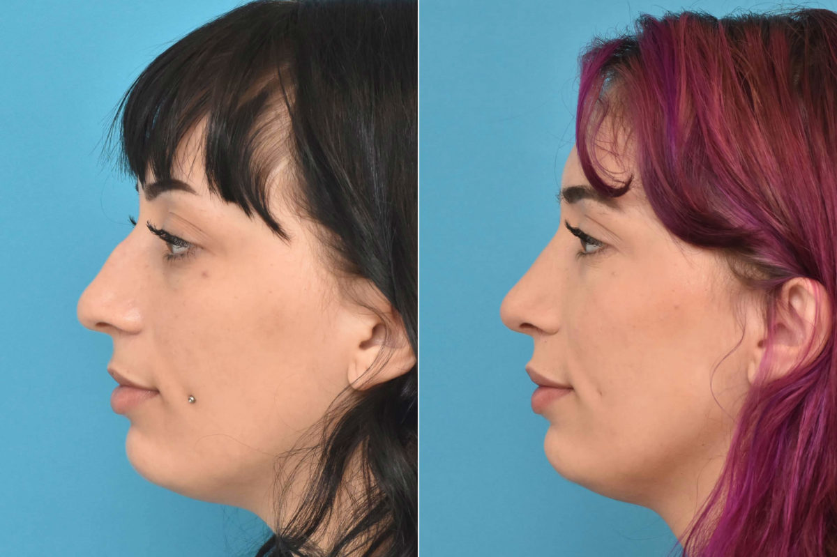 Rhinoplasty Before and After Photos in Philadelphia, PA, Patient 3311