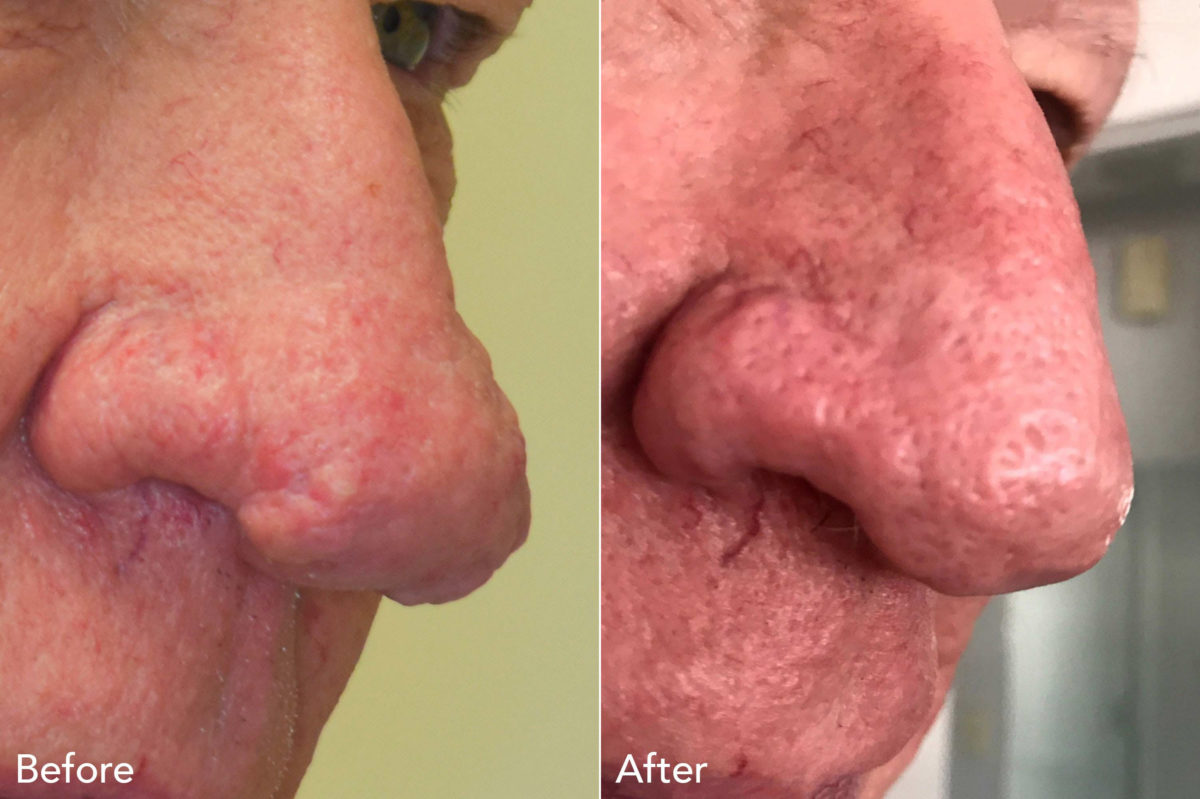 Rhinophyma Before and After Photos in Philadelphia, PA, Patient 3316