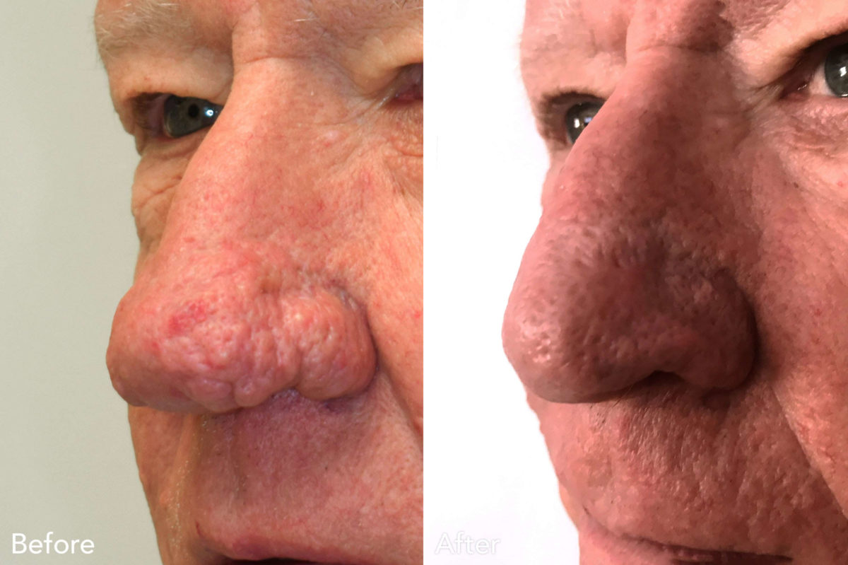 Rhinophyma Before and After Photos in Philadelphia, PA, Patient 3316