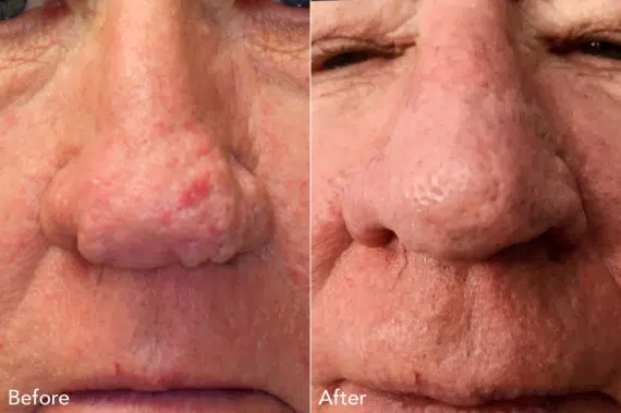 Rhinophyma Before and After Photos in Philadelphia, PA, Patient 3316