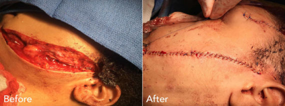 Reconstructive Surgery Before and After Photos in Philadelphia, PA, Patient 3342