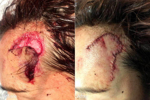 Reconstructive Surgery Before and After Photos in Philadelphia, PA, Patient 3344