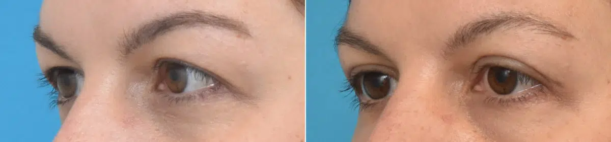 Blepharoplasty Before and After Photos in Philadelphia, PA, Patient 3354