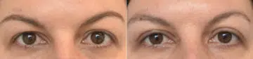 Blepharoplasty Before and After Photos in Philadelphia, PA, Patient 3354