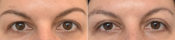 Blepharoplasty Before and After Photos in Philadelphia, PA, Patient 3354