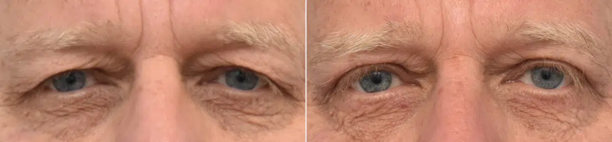 Blepharoplasty Before and After Photos in Philadelphia, PA, Patient 3357