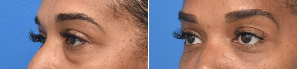 Blepharoplasty Before and After Photos in Philadelphia, PA, Patient 3359