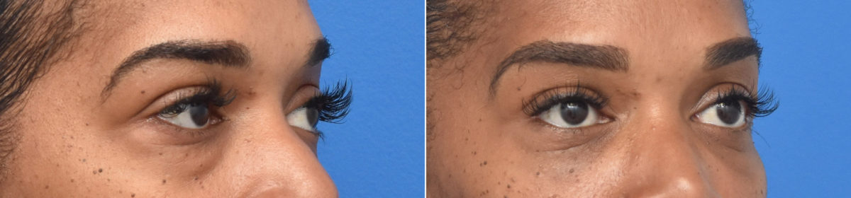 Blepharoplasty Before and After Photos in Philadelphia, PA, Patient 3359