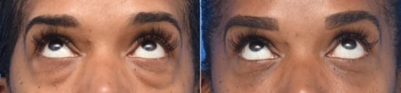 Blepharoplasty Before and After Photos in Philadelphia, PA, Patient 3359