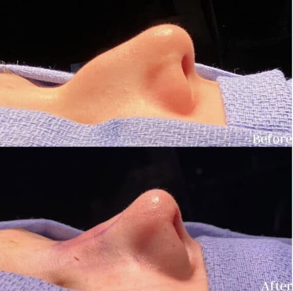 Immediate Rhinoplasty Before and After Photos in Philadelphia, PA, Patient 3364