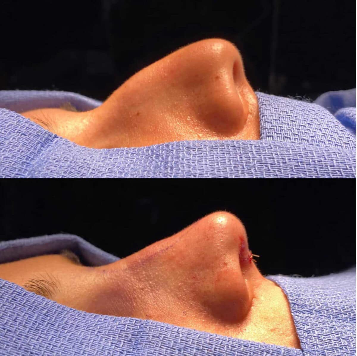 Immediate Rhinoplasty Before and After Photos in Philadelphia, PA, Patient 3381