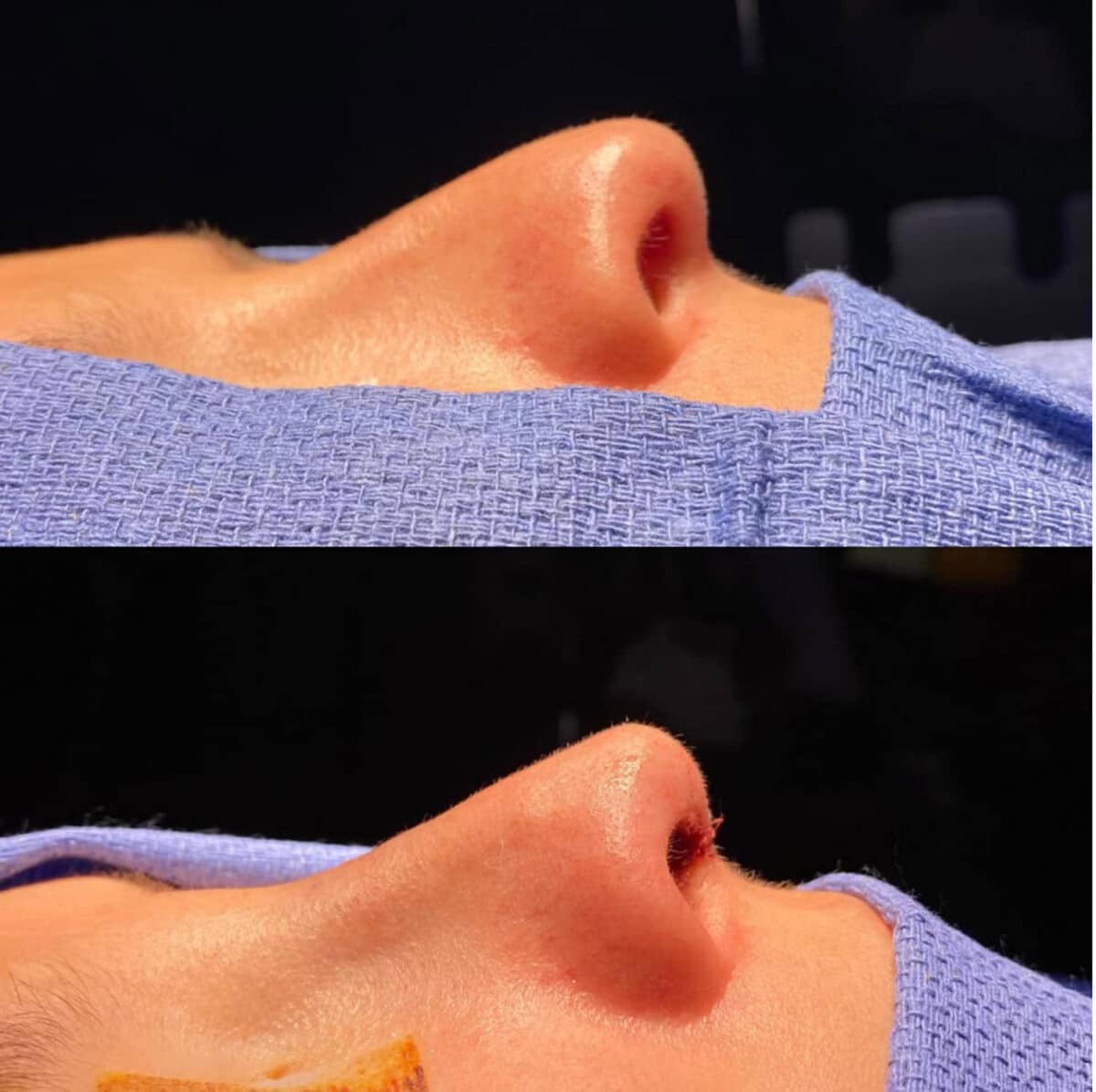 Immediate Rhinoplasty Before and After Photos in Philadelphia, PA, Patient 3383