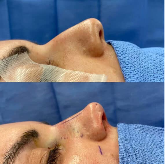 Immediate Rhinoplasty Before and After Photos in Philadelphia, PA, Patient 3385