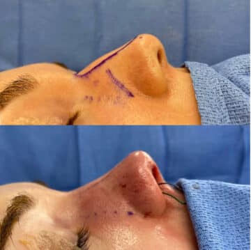 Immediate Rhinoplasty Before and After Photos in Philadelphia, PA, Patient 3387