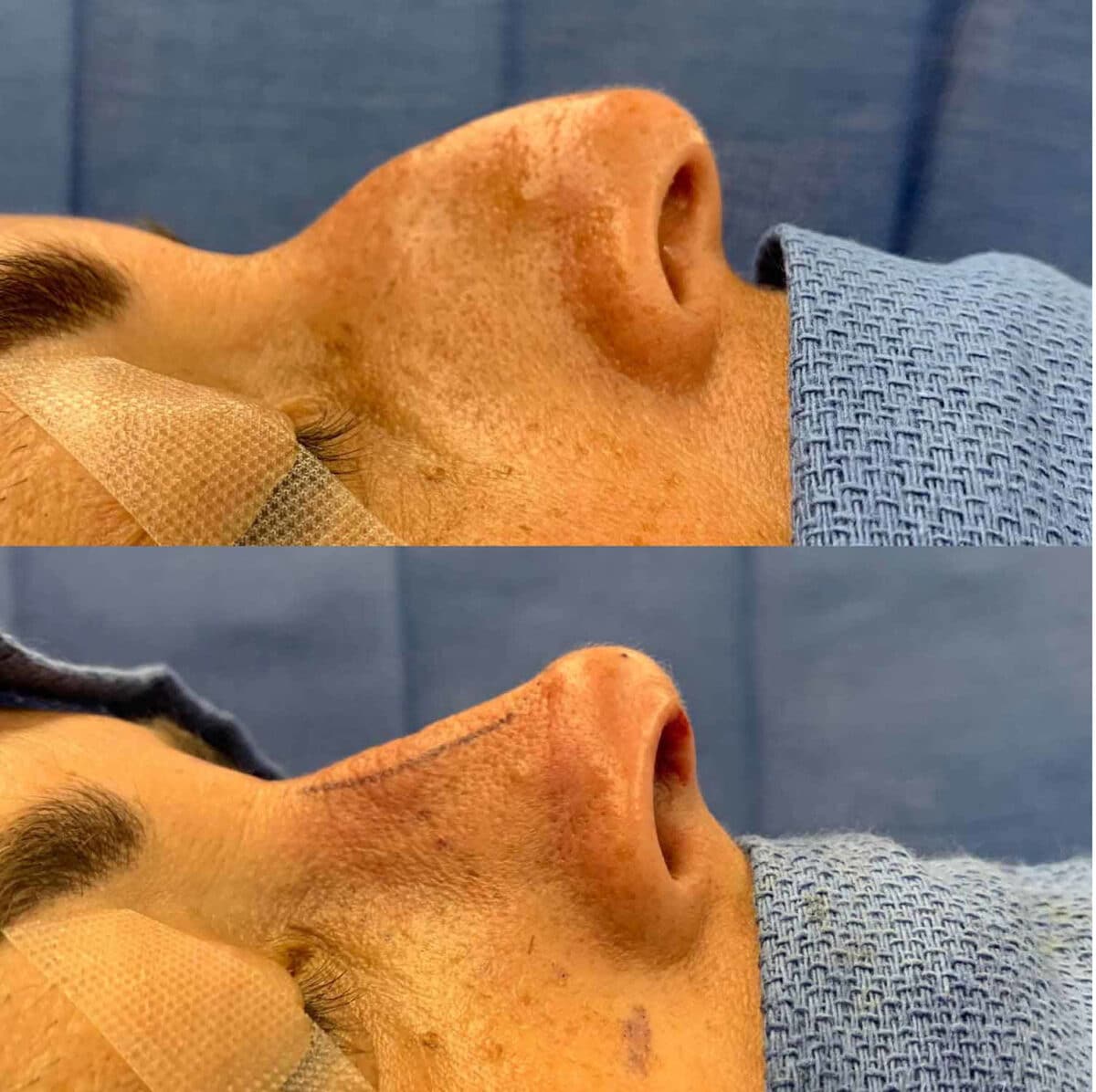 Immediate Rhinoplasty Before and After Photos in Philadelphia, PA, Patient 3389