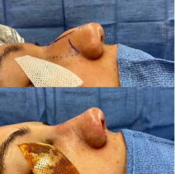 Immediate Rhinoplasty Before and After Photos in Philadelphia, PA, Patient 3391