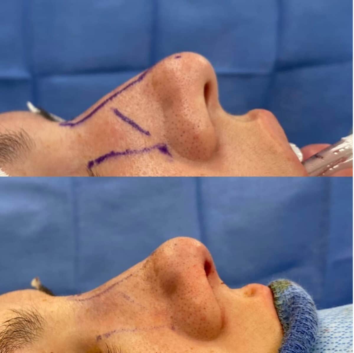 Immediate Rhinoplasty Before and After Photos in Philadelphia, PA, Patient 3393