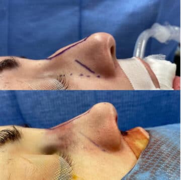 Immediate Rhinoplasty Before and After Photos in Philadelphia, PA, Patient 3395