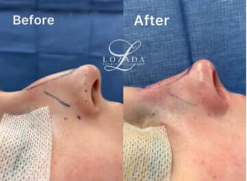 Immediate Rhinoplasty Before and After Photos in Philadelphia, PA, Patient 3397