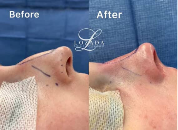 Immediate Rhinoplasty Before and After Photos in Philadelphia, PA, Patient 3397